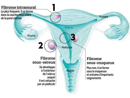type de fibrome type de fibrome