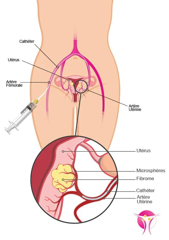 traitement fibrome traitement fibrome
